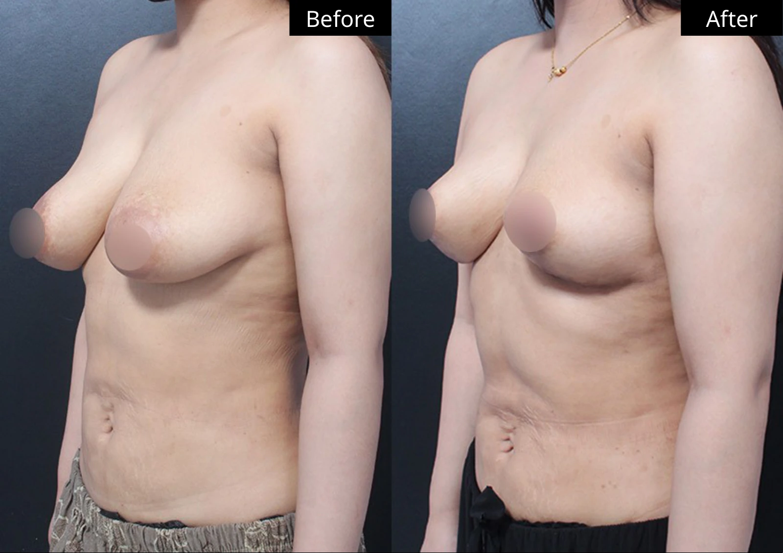 Verygood Plastic Surgery: Breast lift and reduction — angled view · 11. Before on the left; after on the right.