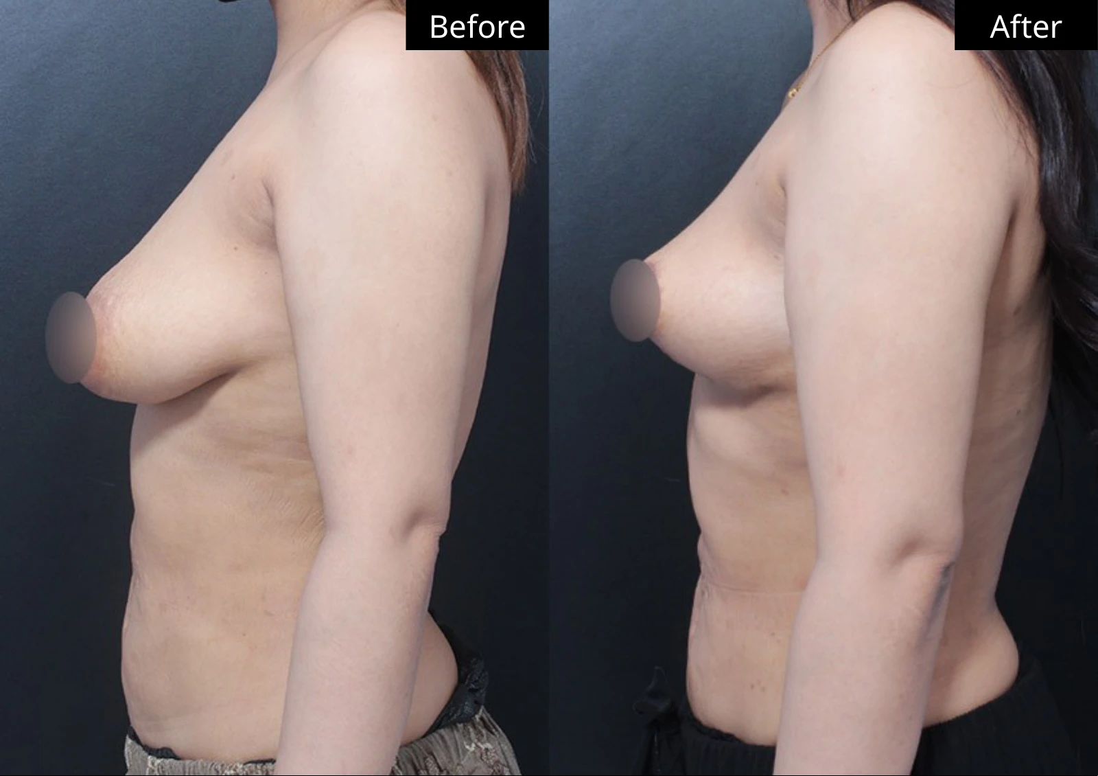Verygood Plastic Surgery: Breast lift and reduction — side profile · 12. Before on the left; after on the right.