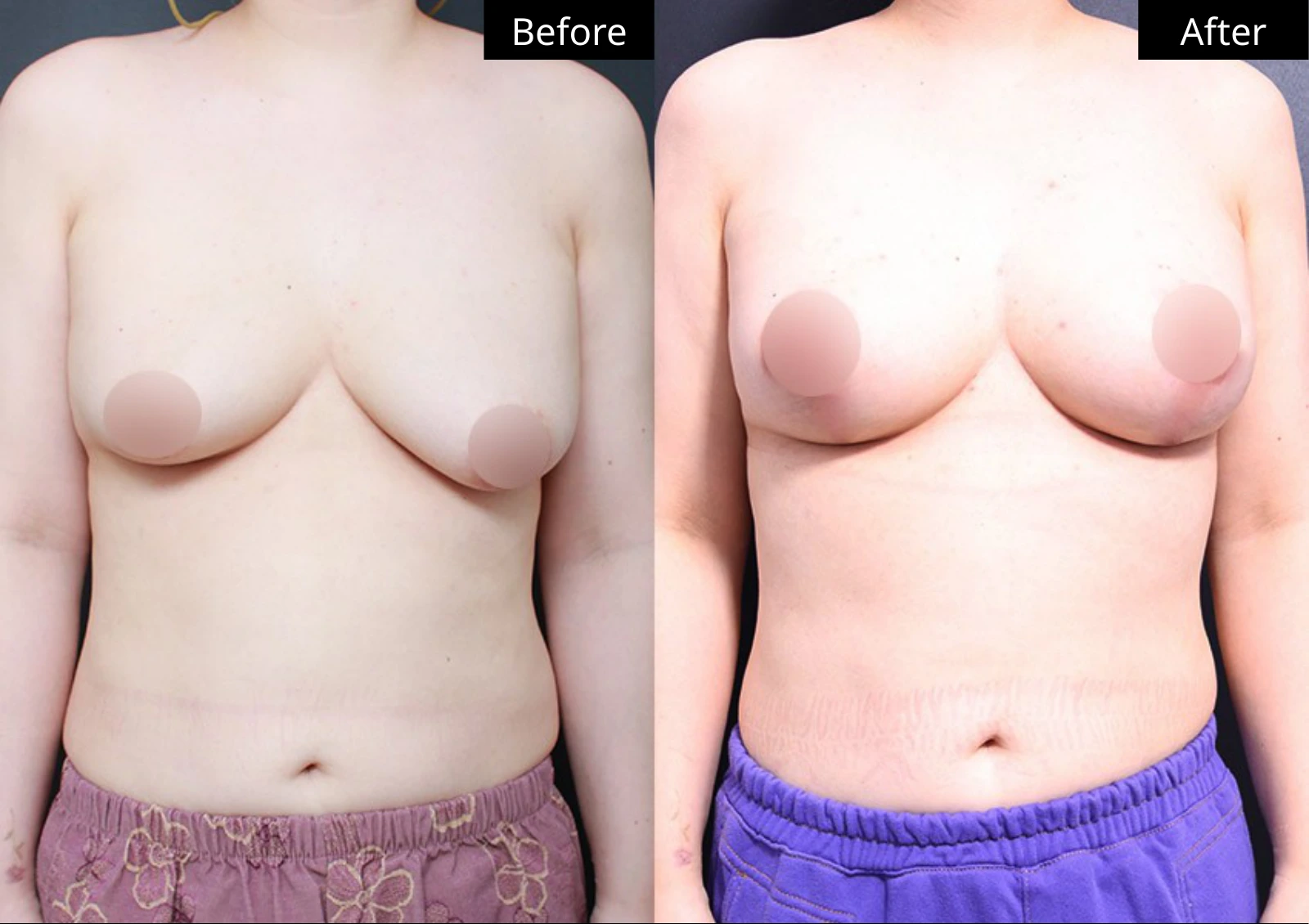 Verygood Plastic Surgery: Breast lift and reduction — front view · 13. Before on the left; after on the right.