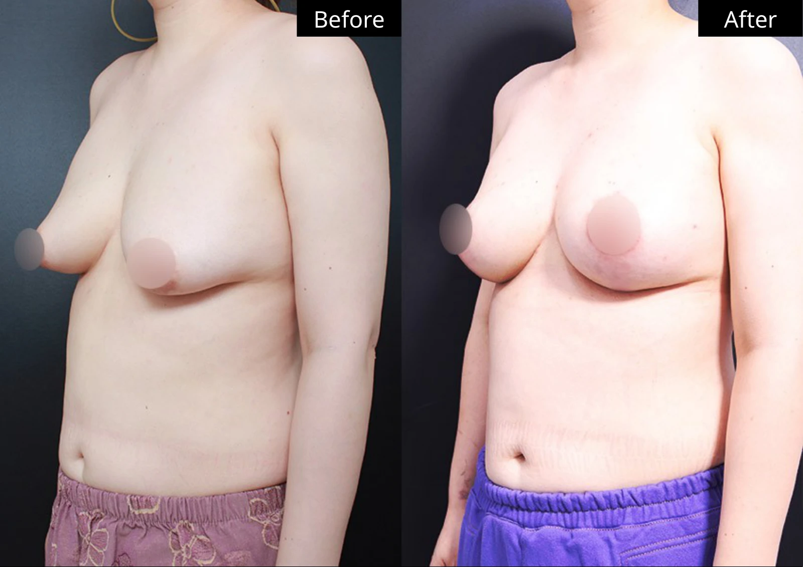 Verygood Plastic Surgery: Breast lift and reduction — angled view · 14. Before on the left; after on the right.