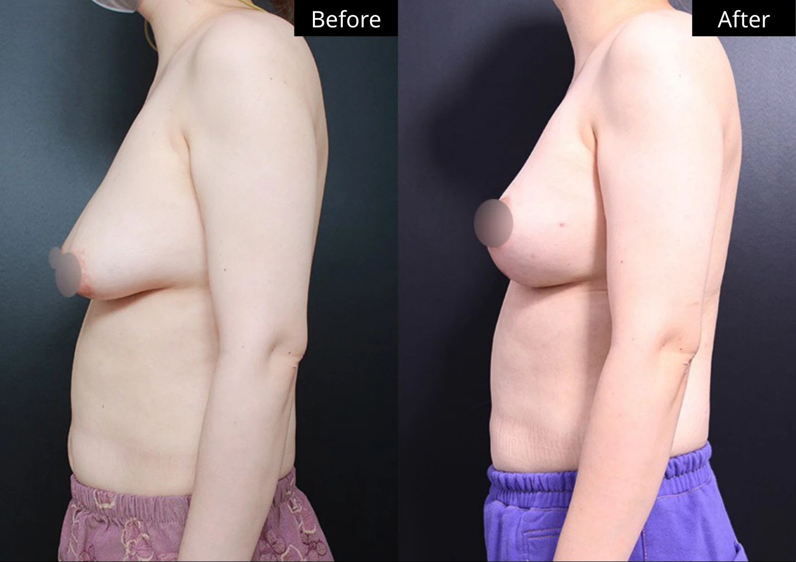 Verygood Plastic Surgery: Breast lift and reduction — side profile · 15. Before on the left; after on the right.