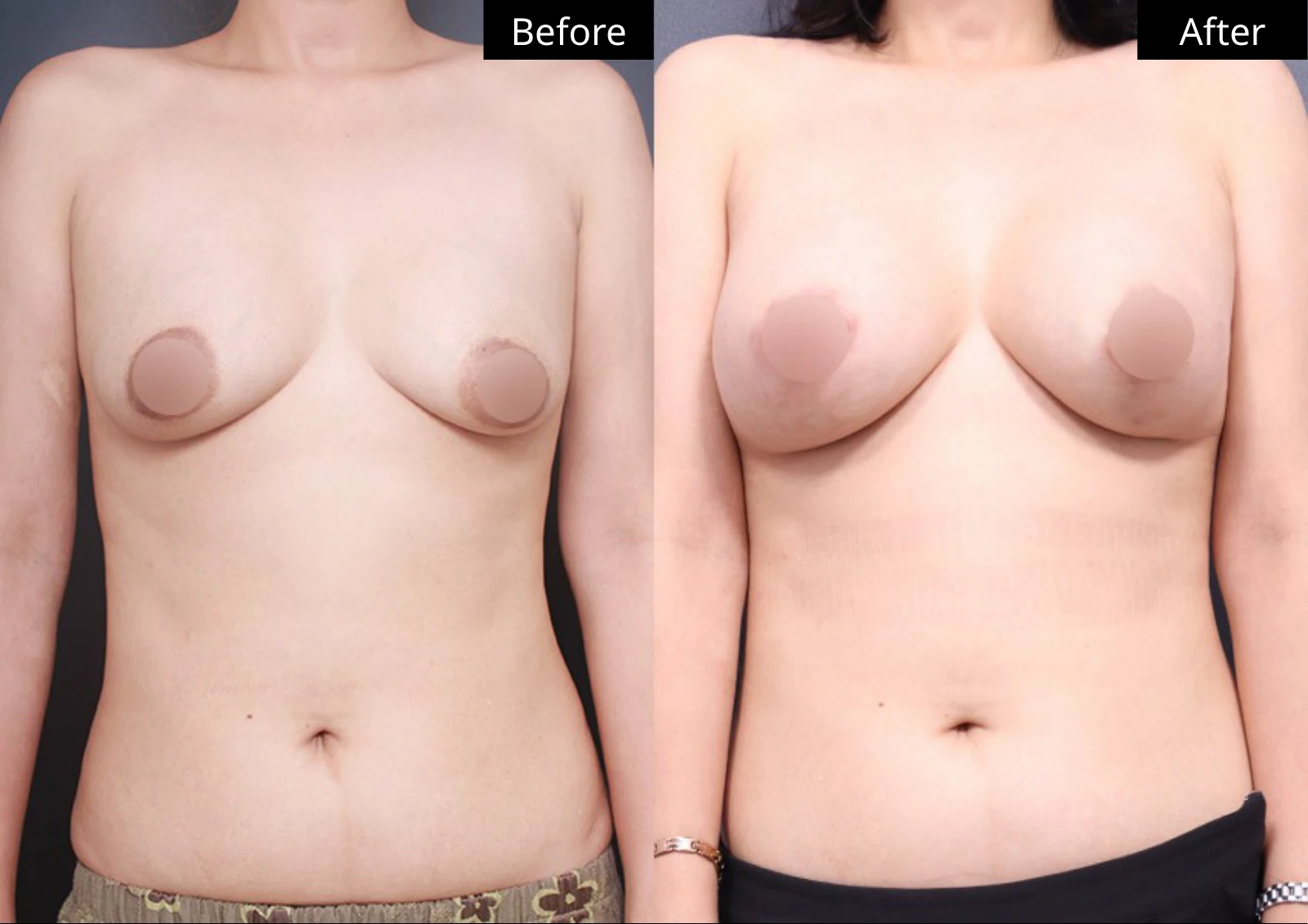 Verygood Plastic Surgery: Breast lift and reduction — front view · 16. Before on the left; after on the right.