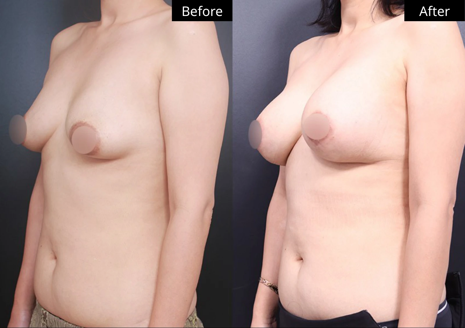 Verygood Plastic Surgery: Breast lift and reduction — angled view · 17. Before on the left; after on the right.