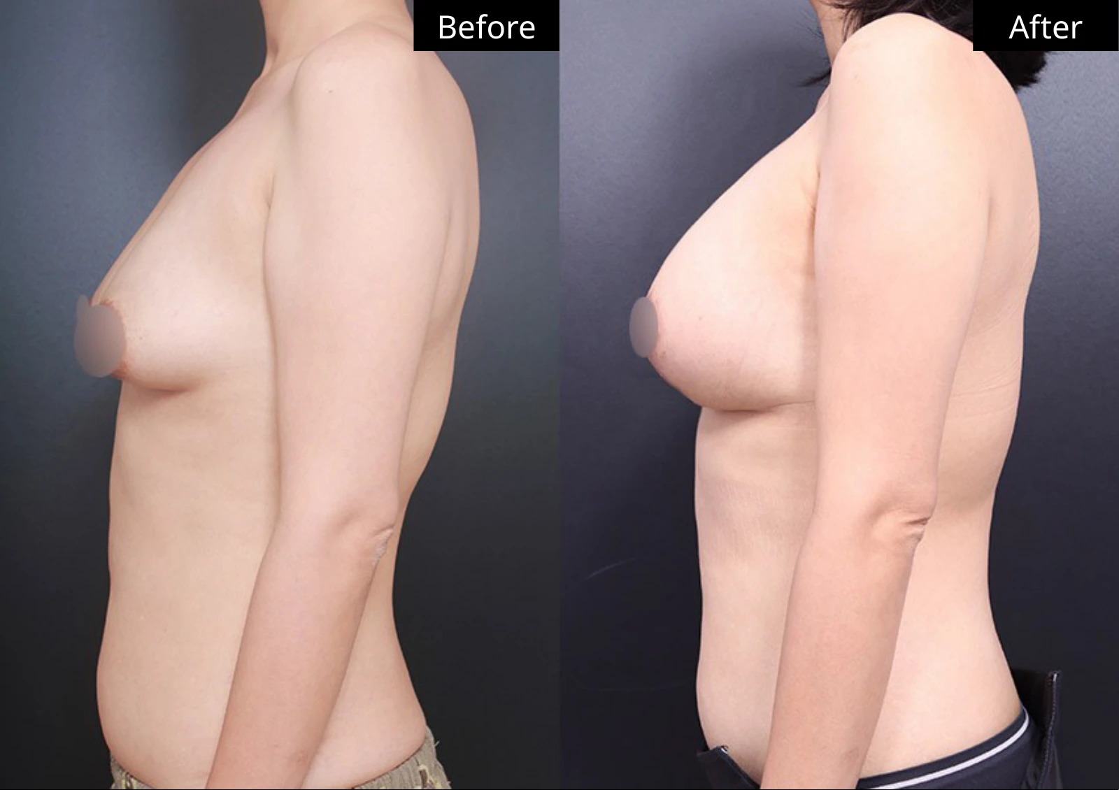Verygood Plastic Surgery: Breast lift and reduction — side profile · 18. Before on the left; after on the right.