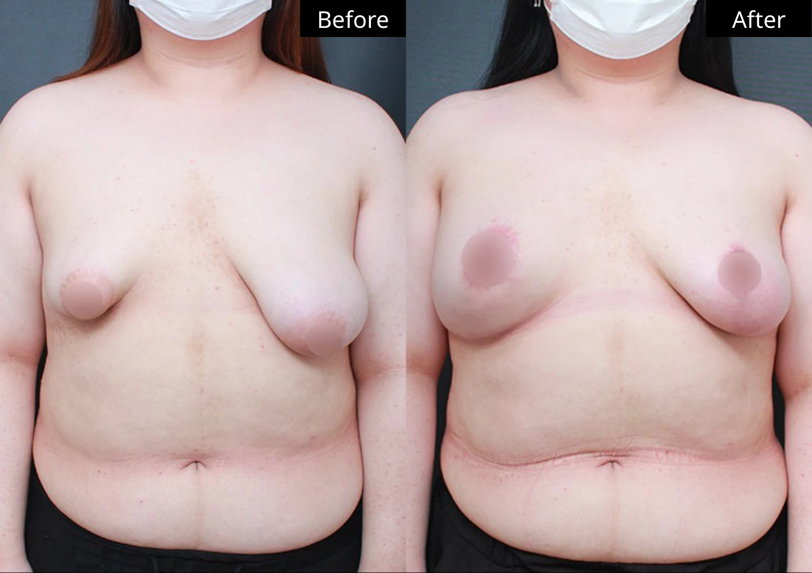 Verygood Plastic Surgery: Breast lift and reduction — front view · 19. Before on the left; after on the right.