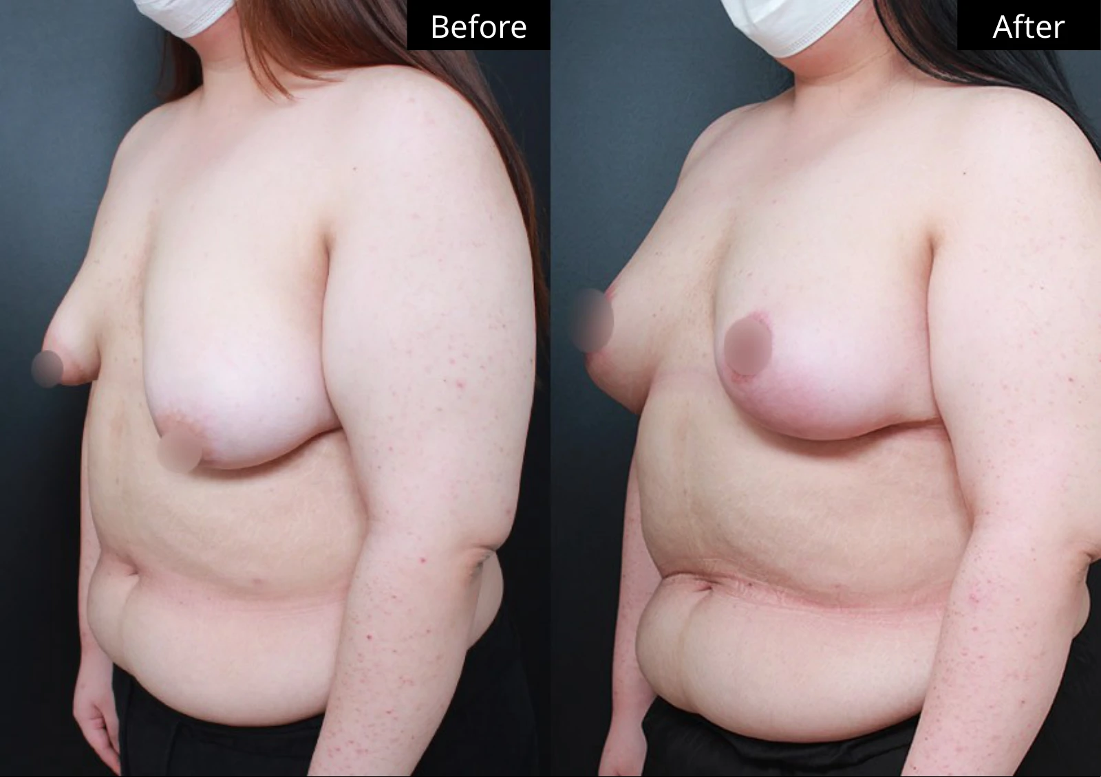 Verygood Plastic Surgery: Breast lift and reduction — angled view · 20. Before on the left; after on the right.