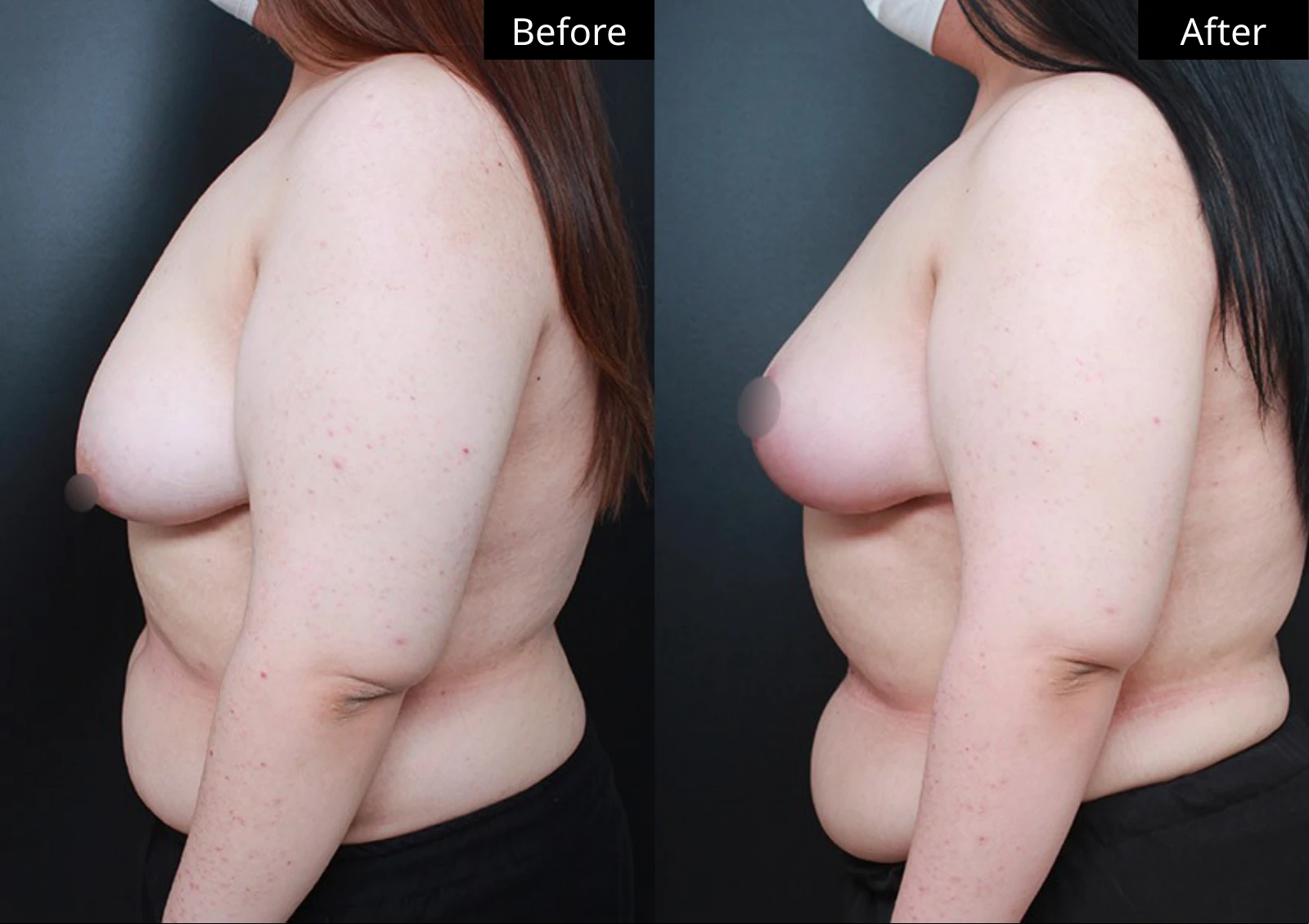 Verygood Plastic Surgery: Breast lift and reduction — side profile · 21. Before on the left; after on the right.