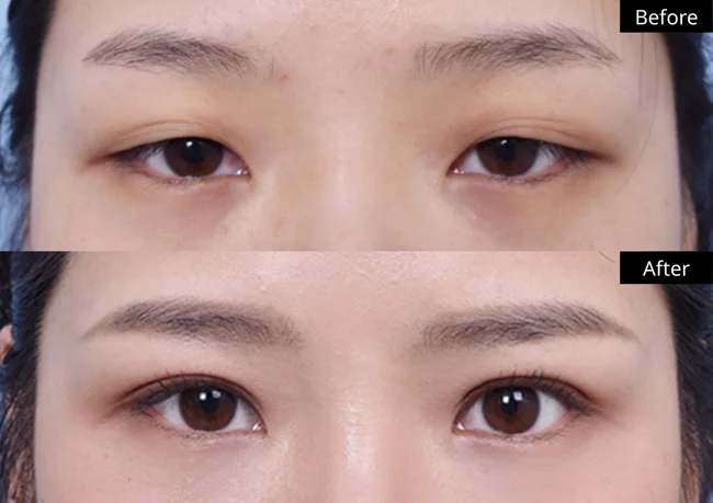 Eyelid surgery — front view · 01 before and after at Verygood Plastic Surgery