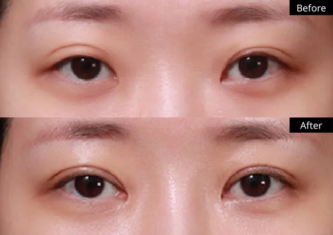 Eyelid surgery — front view · 02 before and after at Verygood Plastic Surgery