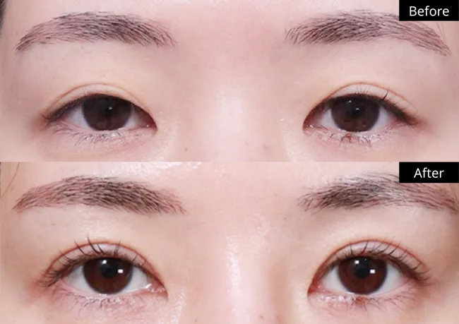 Eyelid surgery — front view · 03 before and after at Verygood Plastic Surgery