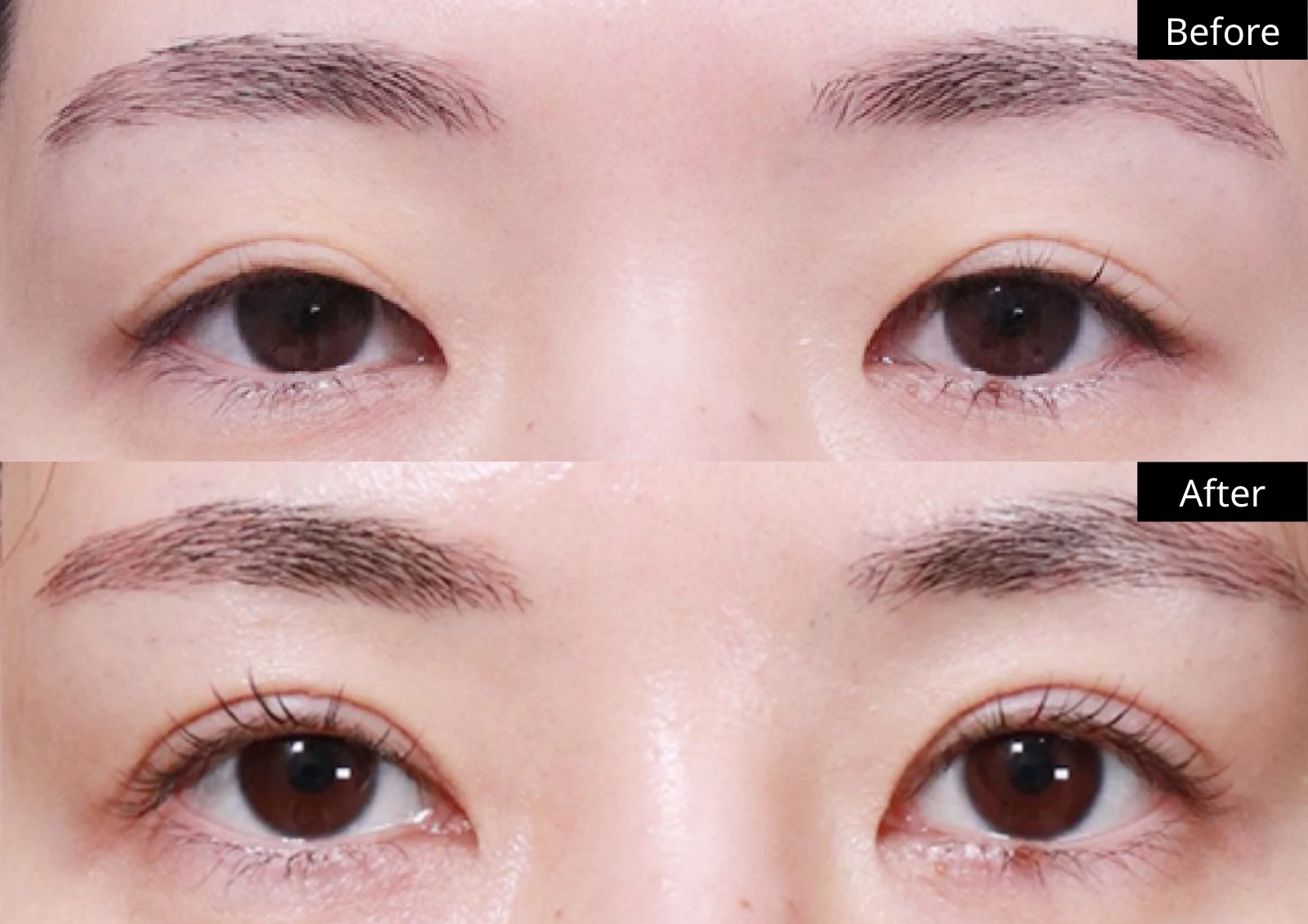 Verygood Plastic Surgery: Eyelid surgery — front view · 03. Before above; after below.