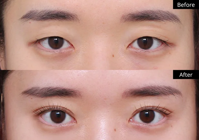 Eyelid surgery — front view · 04 before and after at Verygood Plastic Surgery