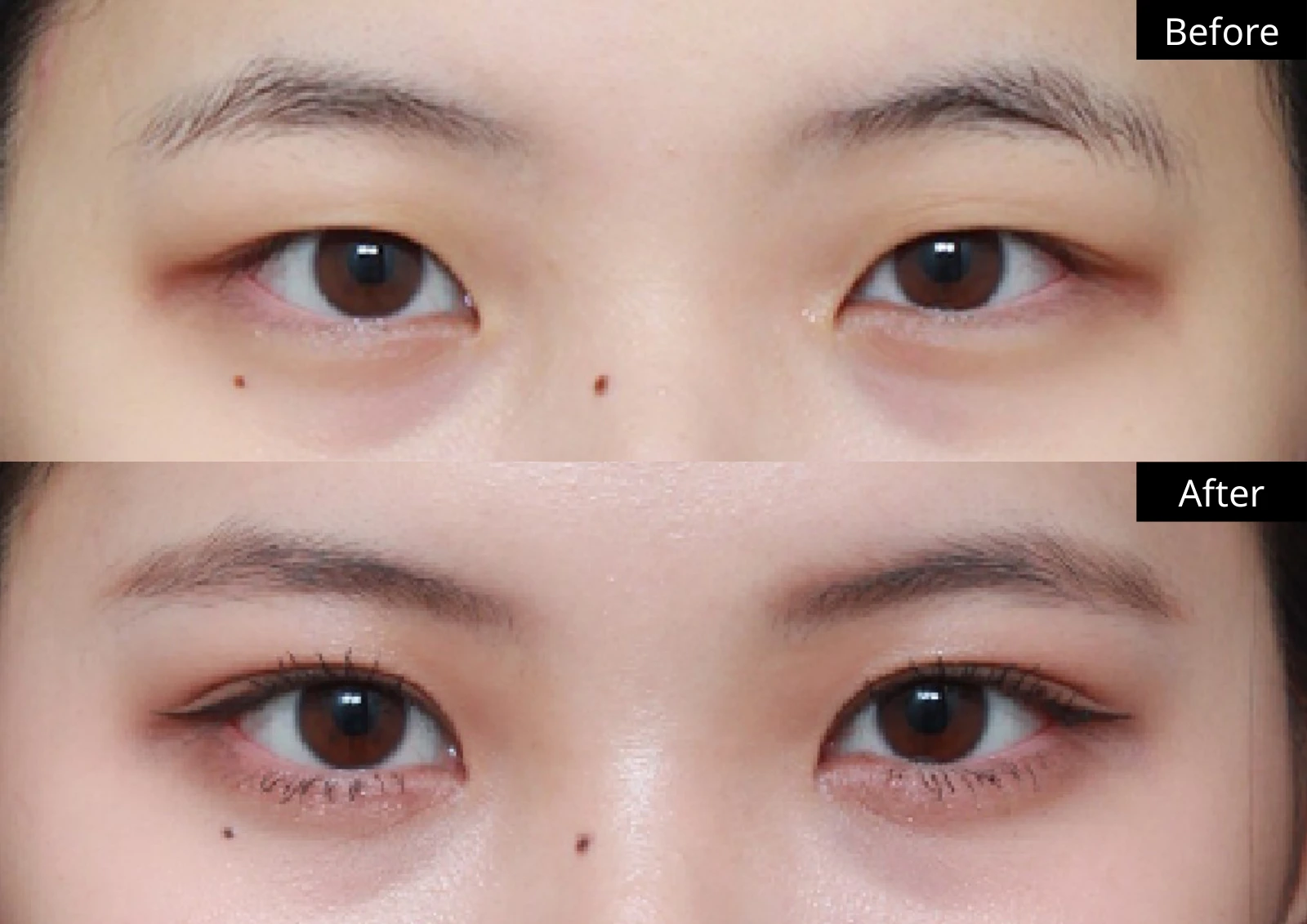 Verygood Plastic Surgery: Eyelid surgery — front view · 05. Before above; after below.