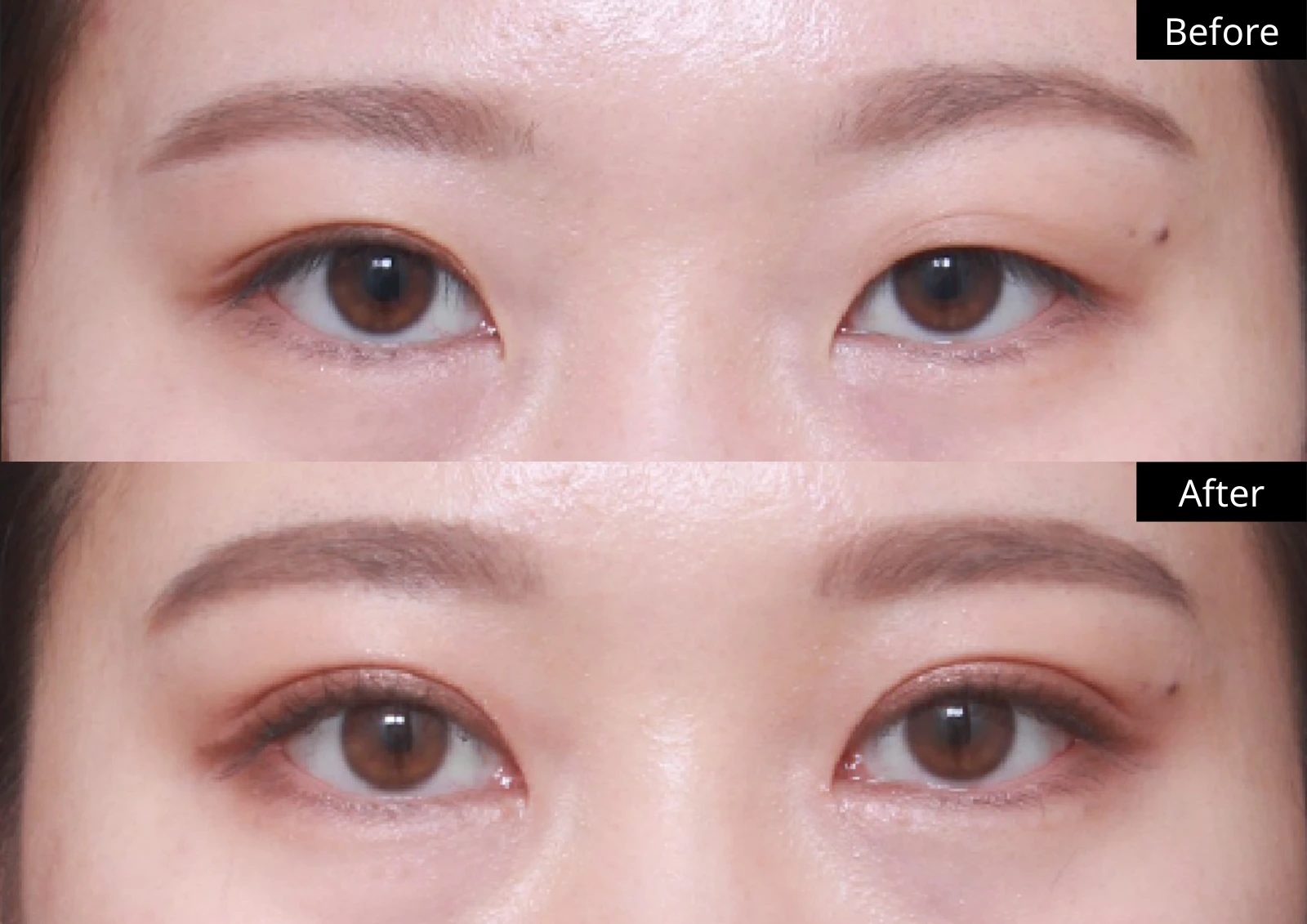 Verygood Plastic Surgery: Eyelid surgery — front view · 06. Before above; after below.
