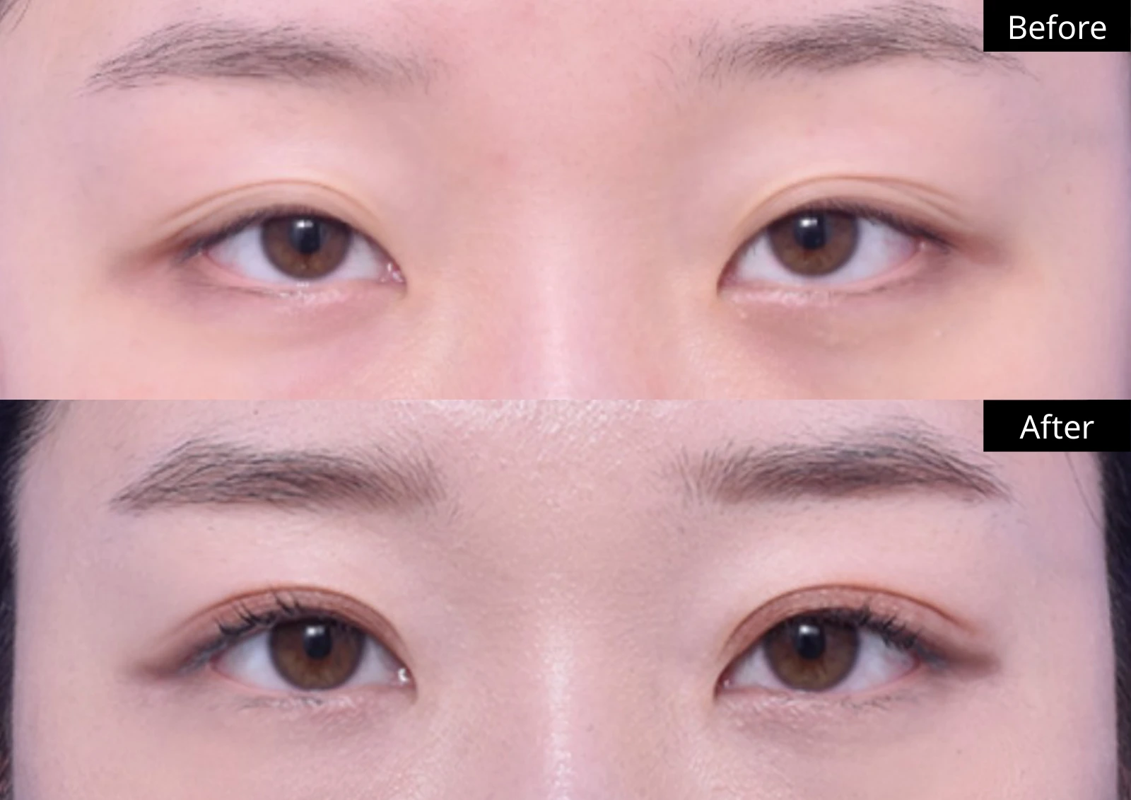 Verygood Plastic Surgery: Eyelid surgery — front view · 07. Before above; after below.