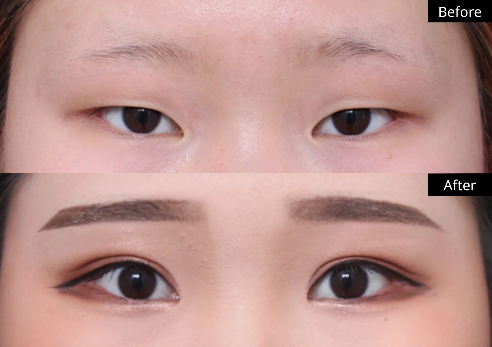 Verygood Plastic Surgery: Eyelid surgery — front view · 08. Before above; after below.