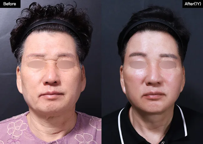 Facelift — front view, 1 year · 04 before and after at Verygood Plastic Surgery