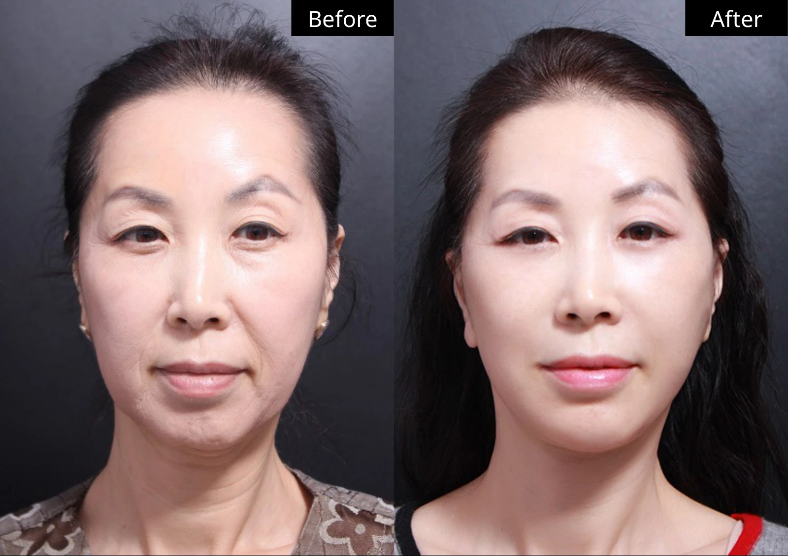 Verygood Plastic Surgery: Facial fat grafting — front view · 10. Before on the left; after on the right.