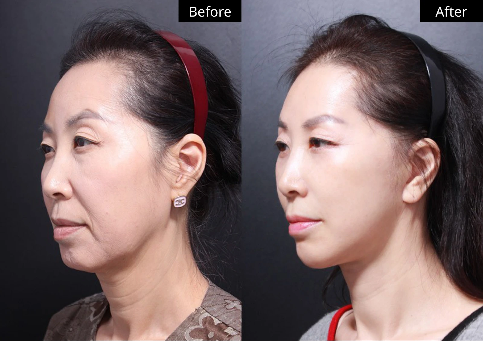 Verygood Plastic Surgery: Facial fat grafting — angled view · 11. Before on the left; after on the right.