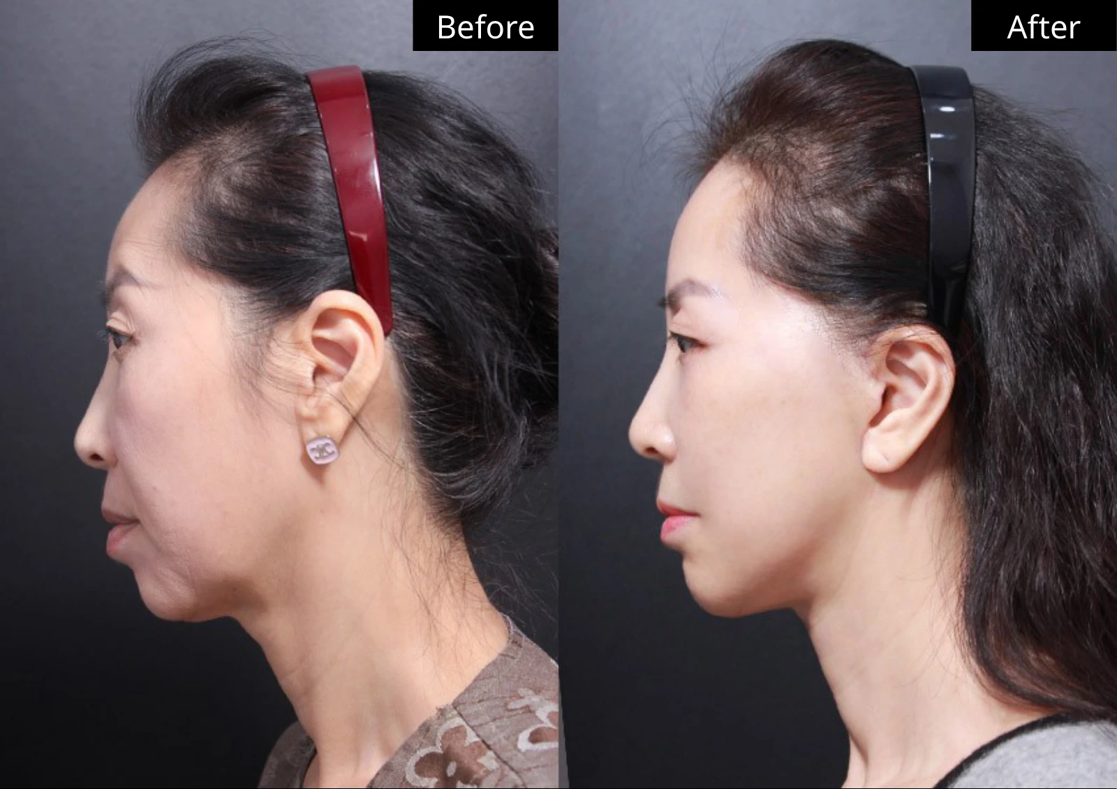 Verygood Plastic Surgery: Facial fat grafting — side profile · 12. Before on the left; after on the right.