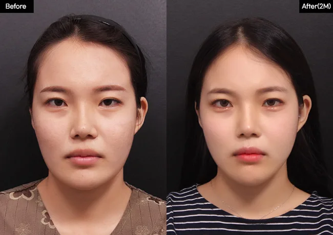Facial contouring — front view, 2 months · 01 before and after at Verygood Plastic Surgery
