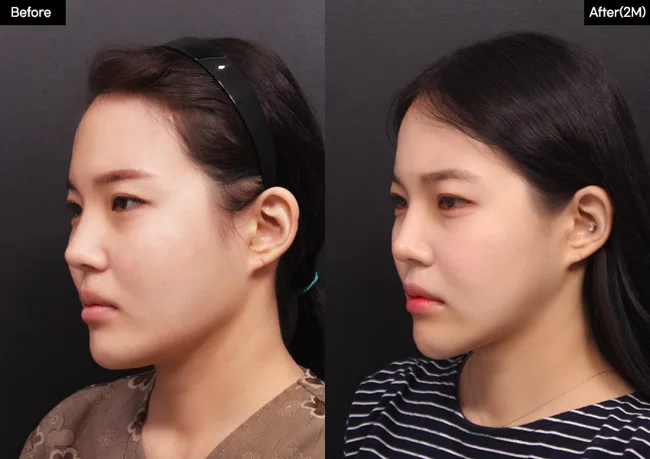 Facial contouring — angled view, 2 months · 02 before and after at Verygood Plastic Surgery