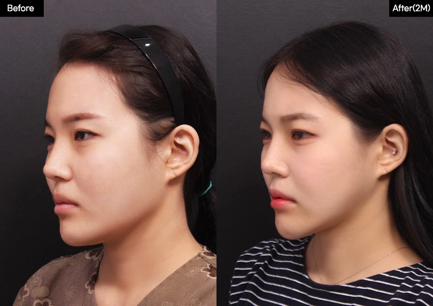 Verygood Plastic Surgery: Facial contouring — angled view, 2 months · 02. Before on the left; after on the right.