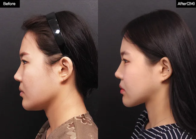Facial contouring — side profile, 2 months · 03 before and after at Verygood Plastic Surgery