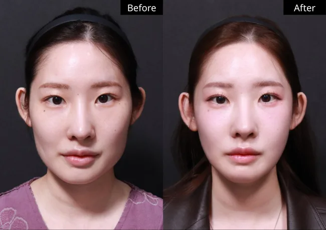 Facial contouring — front view · 04 before and after at Verygood Plastic Surgery