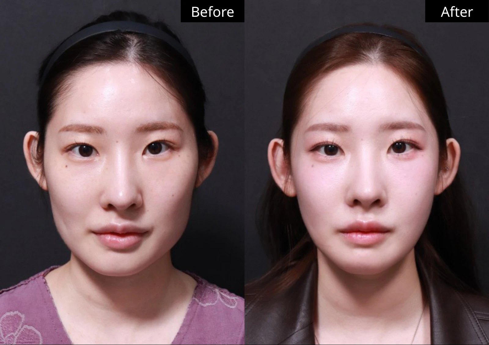 Verygood Plastic Surgery: Facial contouring — front view · 04. Before on the left; after on the right.