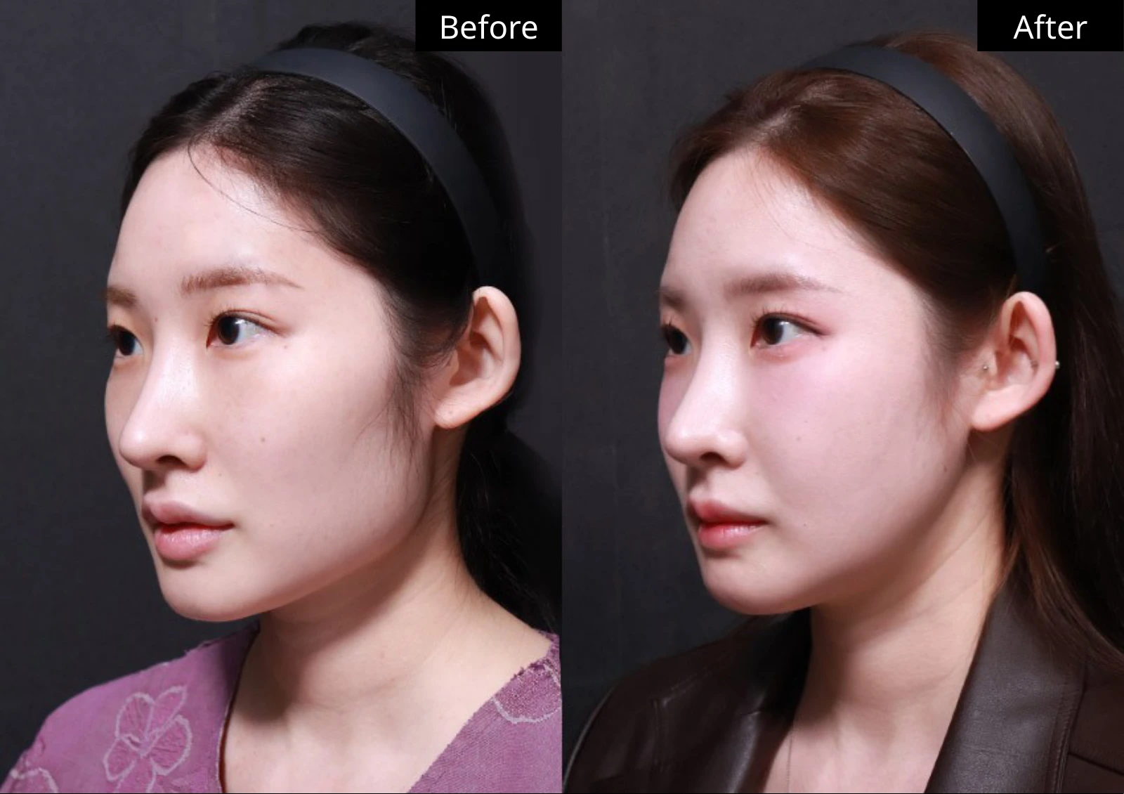 Verygood Plastic Surgery: Facial contouring — angled view · 05. Before on the left; after on the right.