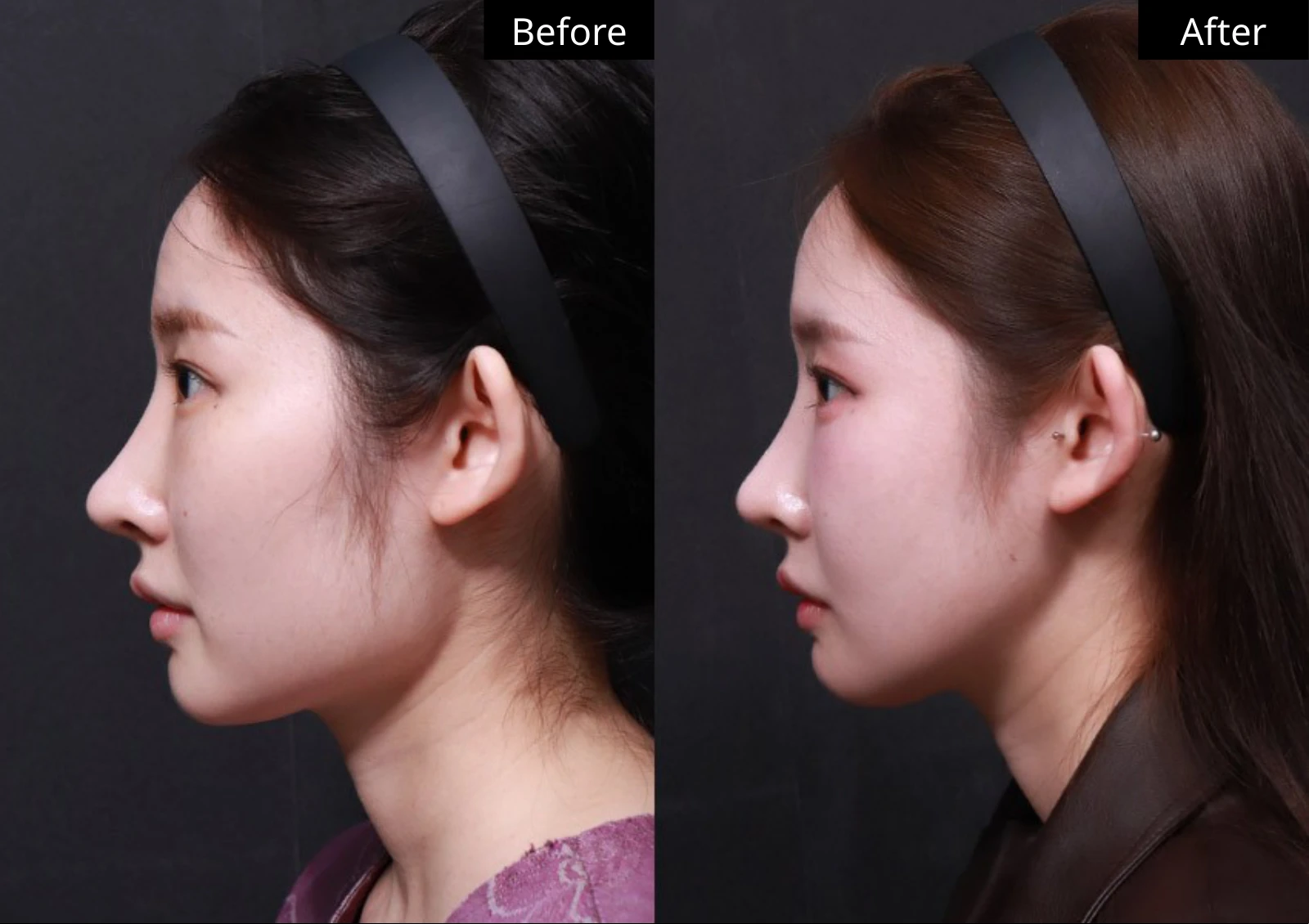 Verygood Plastic Surgery: Facial contouring — side profile · 06. Before on the left; after on the right.