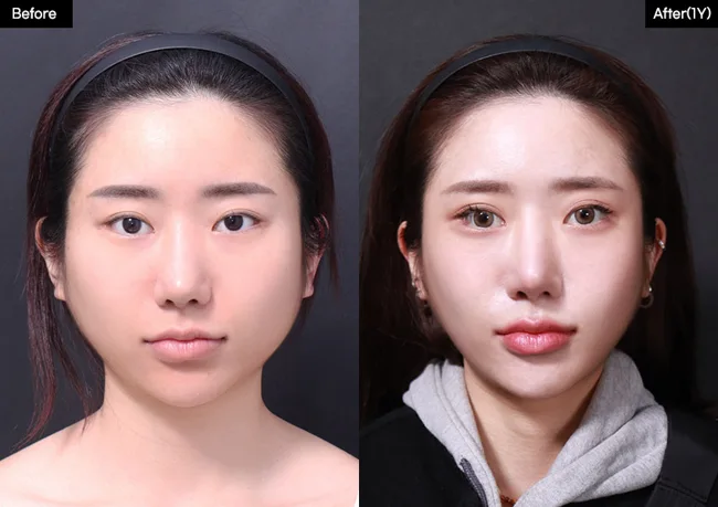 Facial contouring — front view, 1 year · 07 before and after at Verygood Plastic Surgery