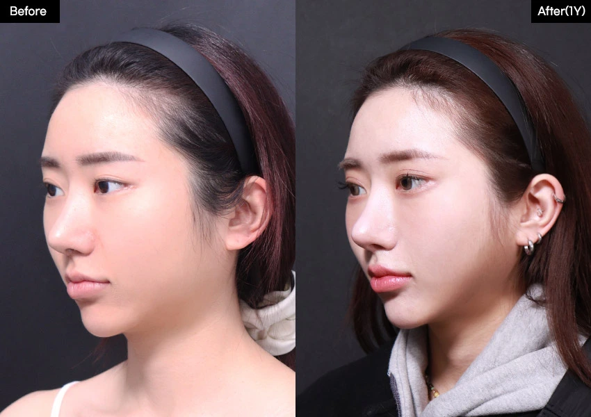 Verygood Plastic Surgery: Facial contouring — angled view, 1 year · 08. Before on the left; after on the right.