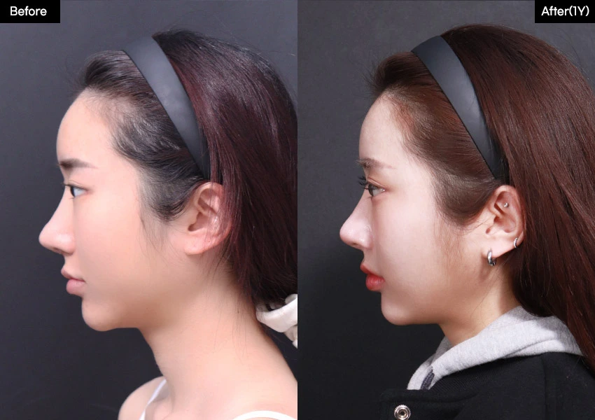 Verygood Plastic Surgery: Facial contouring — side profile, 1 year · 09. Before on the left; after on the right.