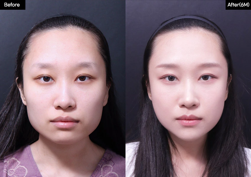 Verygood Plastic Surgery: Facial contouring — front view, 6 months · 10. Before on the left; after on the right.