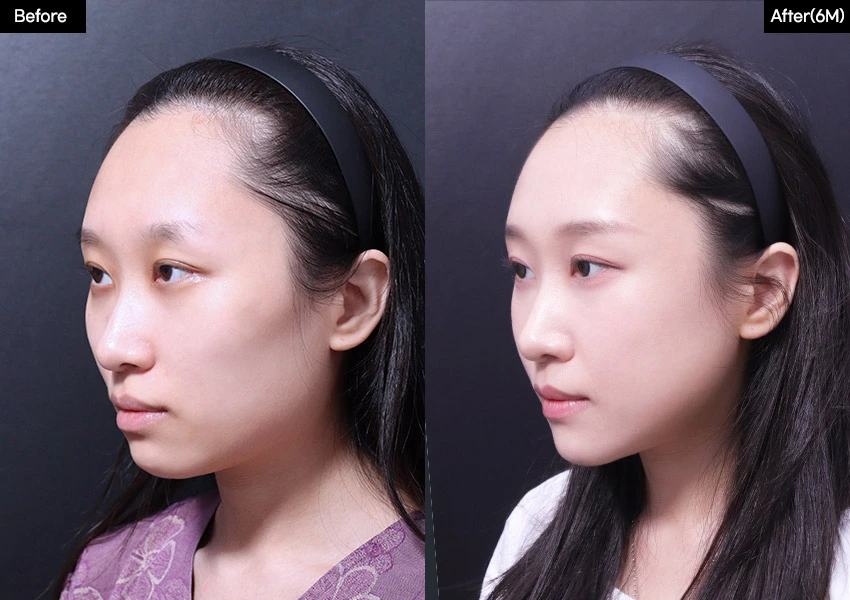 Verygood Plastic Surgery: Facial contouring — angled view, 6 months · 11. Before on the left; after on the right.