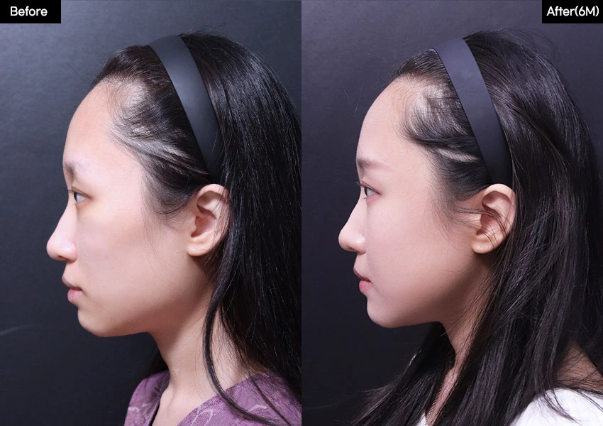 Verygood Plastic Surgery: Facial contouring — side profile, 6 months · 12. Before on the left; after on the right.