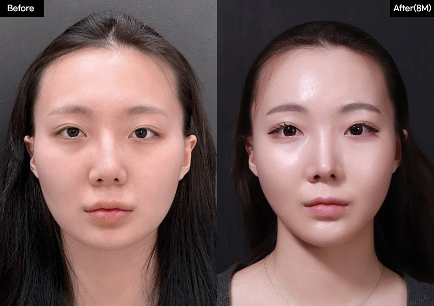 Verygood Plastic Surgery: Facial contouring — front view, 8 months · 13. Before on the left; after on the right.
