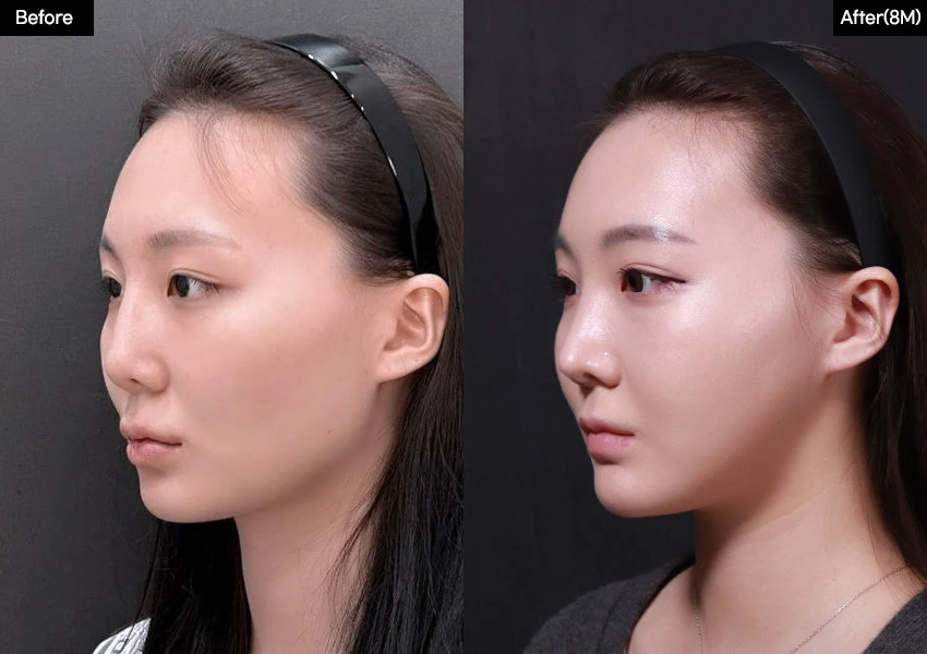 Verygood Plastic Surgery: Facial contouring — angled view, 8 months · 14. Before on the left; after on the right.
