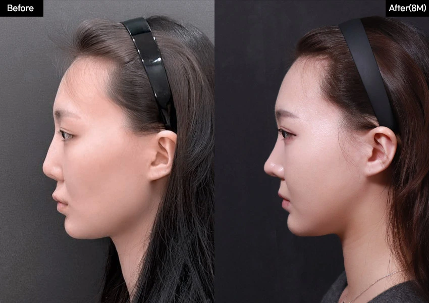 Verygood Plastic Surgery: Facial contouring — side profile, 8 months · 15. Before on the left; after on the right.