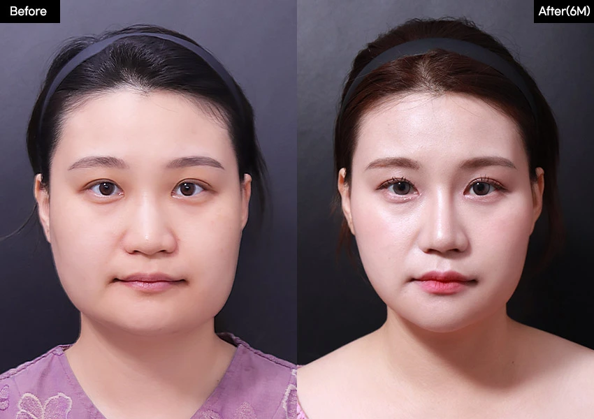 Verygood Plastic Surgery: Facial contouring — front view, 6 months · 16. Before on the left; after on the right.