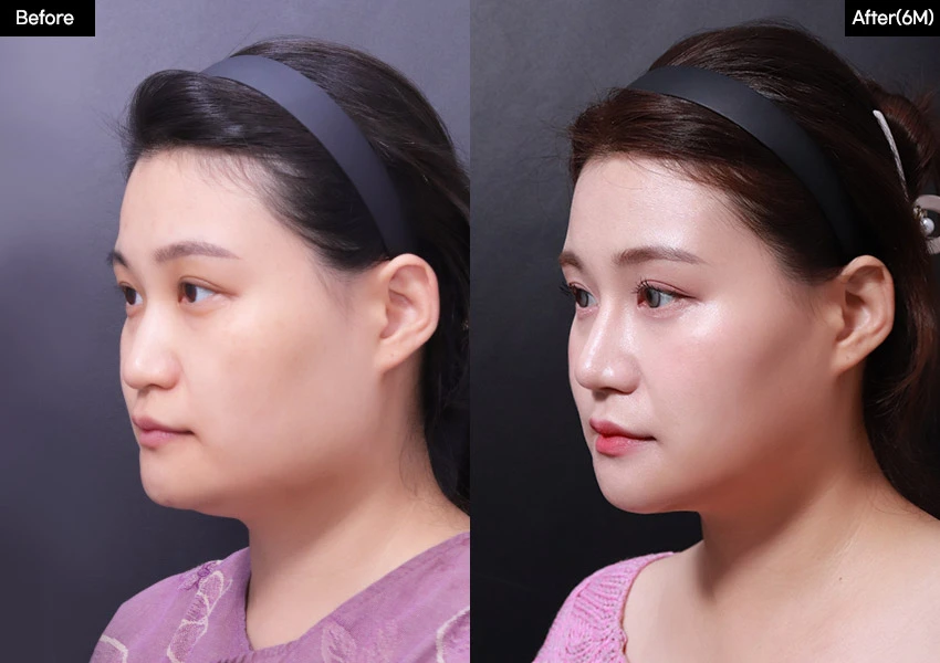 Verygood Plastic Surgery: Facial contouring — angled view, 6 months · 17. Before on the left; after on the right.