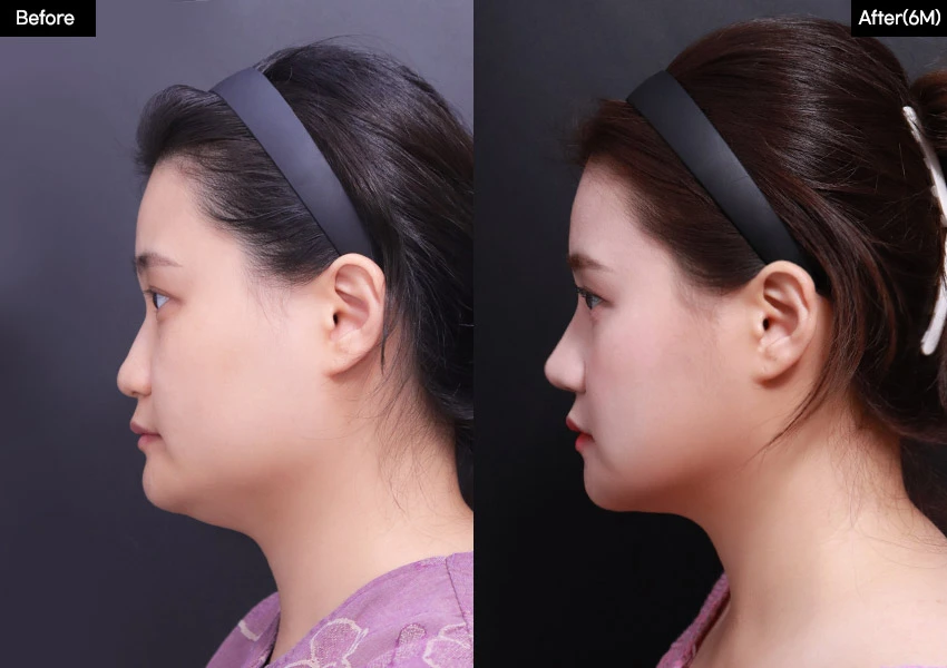 Verygood Plastic Surgery: Facial contouring — side profile, 6 months · 18. Before on the left; after on the right.