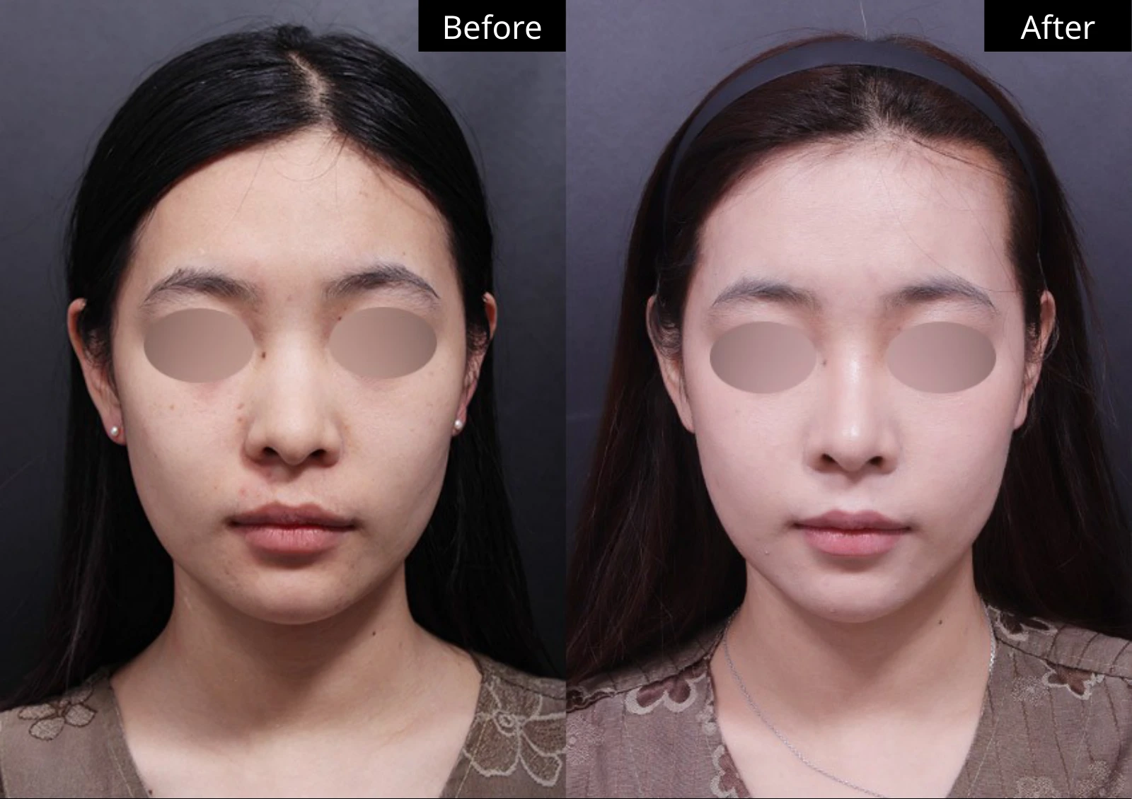 Verygood Plastic Surgery: Facial fat grafting — front view · 01. Before on the left; after on the right.