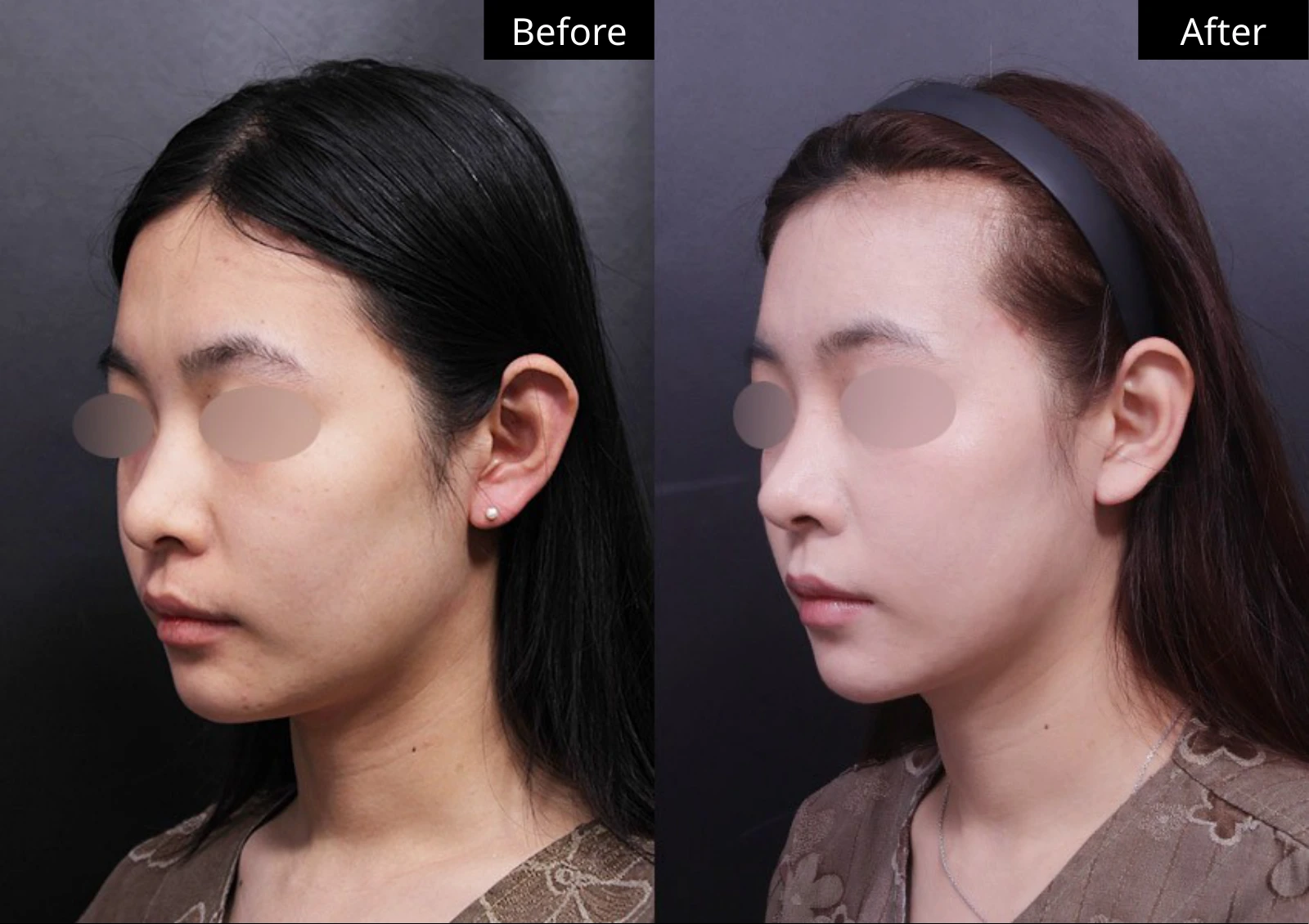 Verygood Plastic Surgery: Facial fat grafting — angled view · 02. Before on the left; after on the right.