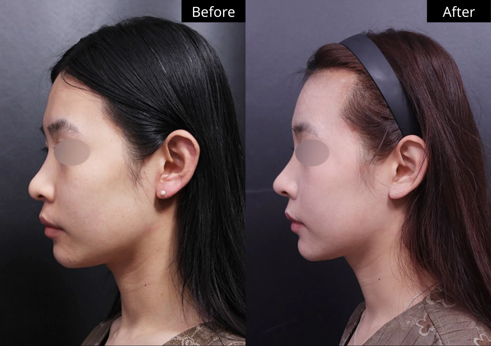 Verygood Plastic Surgery: Facial fat grafting — side profile · 03. Before on the left; after on the right.