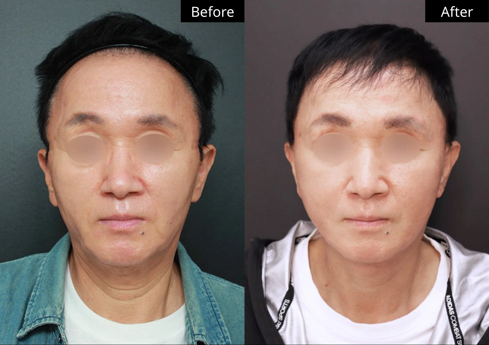 Verygood Plastic Surgery: Facial fat grafting — front view · 04. Before on the left; after on the right.