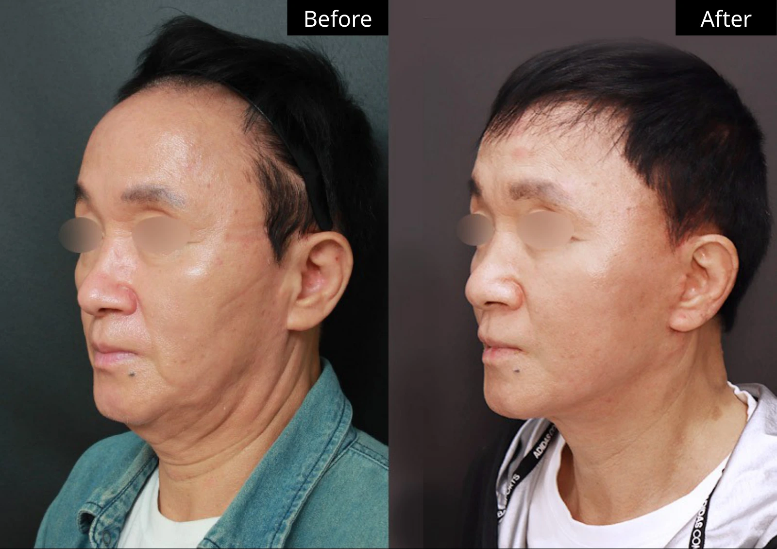 Verygood Plastic Surgery: Facial fat grafting — angled view · 05. Before on the left; after on the right.