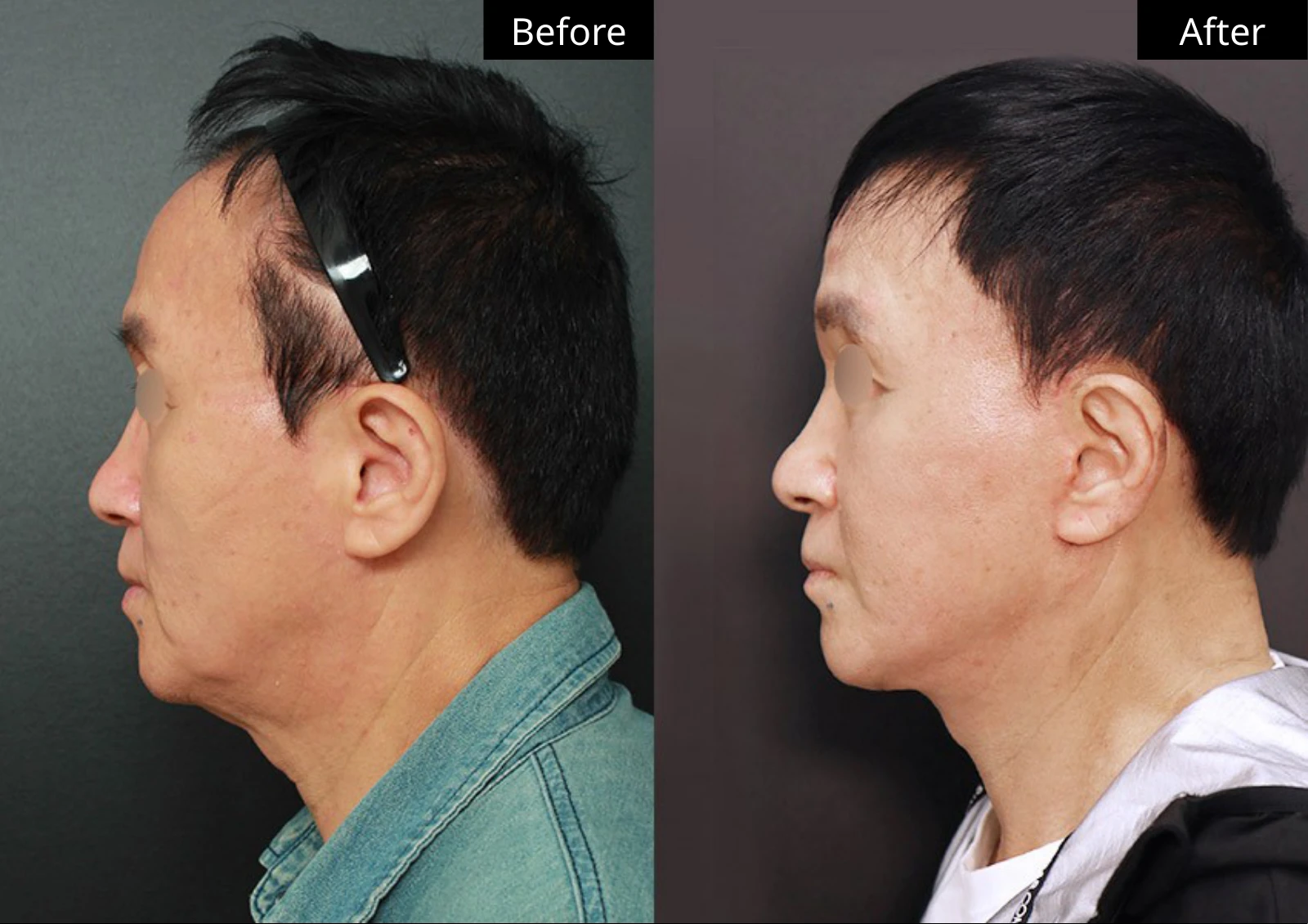 Verygood Plastic Surgery: Facial fat grafting — side profile · 06. Before on the left; after on the right.